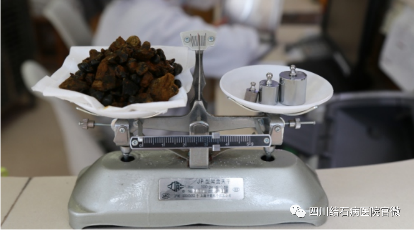 胆结石拖一拖无所谓?四川保胆取石专家:那是你没见识到它的“杀伤力”(图4) 胆结石拖一拖无所谓?四川保胆取石专家:那是你没见识到它的“杀伤力”(图4)