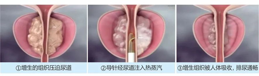 四川结石病医院瑞梦前列腺热蒸汽消融手术突破100例!(图7) 四川结石病医院瑞梦前列腺热蒸汽消融手术突破100例!(图7)