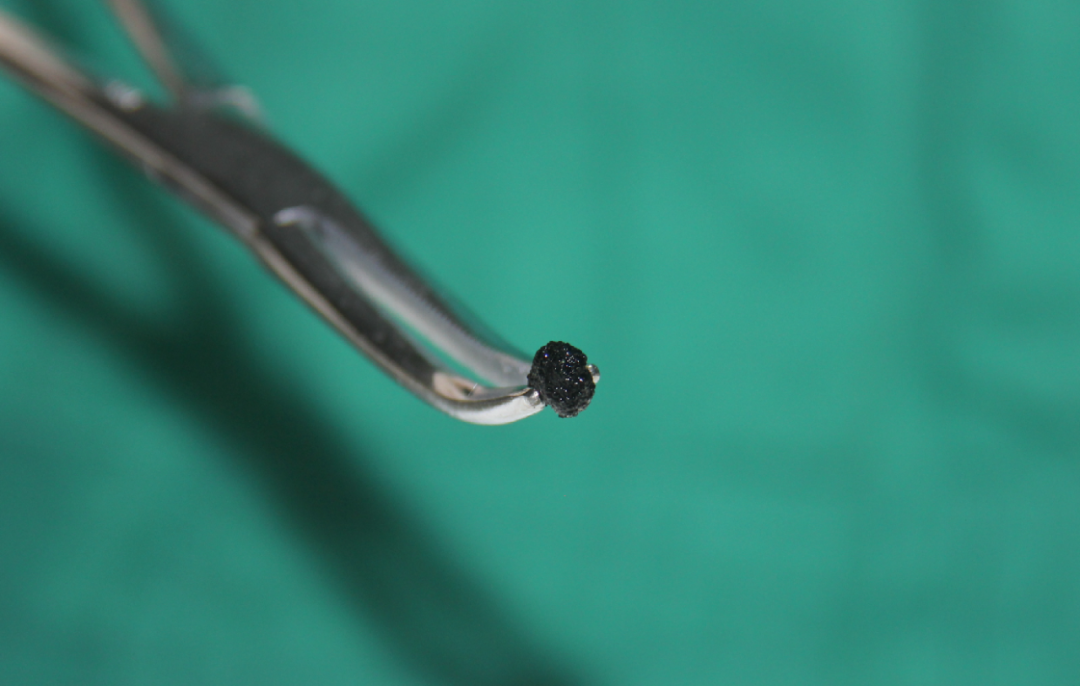 遂宁7岁男孩遭胆结石困扰，父母拒绝切胆求助四川结石病医院！(图1)