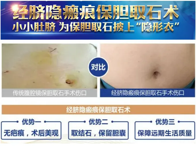 害怕手术、想吃药的胆结石病友，来看看这个患者的亲身经历「成都胆结石医院」(图5)