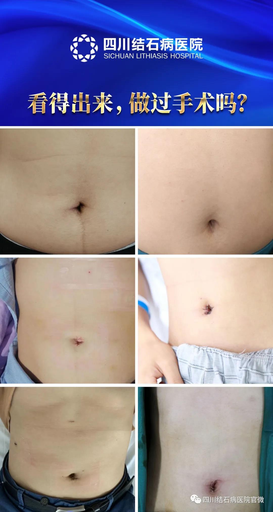 硬实力！四川结石病医院领跑隐痕保胆技术，保胆取石+疤痕隐形！(图1)