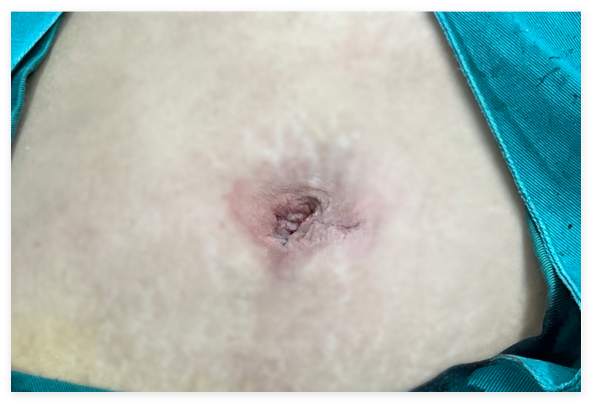 对话保胆者：你们的技术太牛了！伤口根本看不出来！【四川保胆取石医院】(图1)