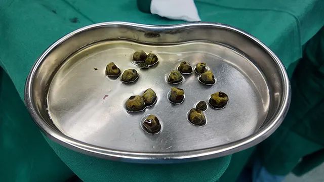 四川胆结石医院案例分享：从无症状拖到有症状，遂宁老太胆囊差点不保(图2)