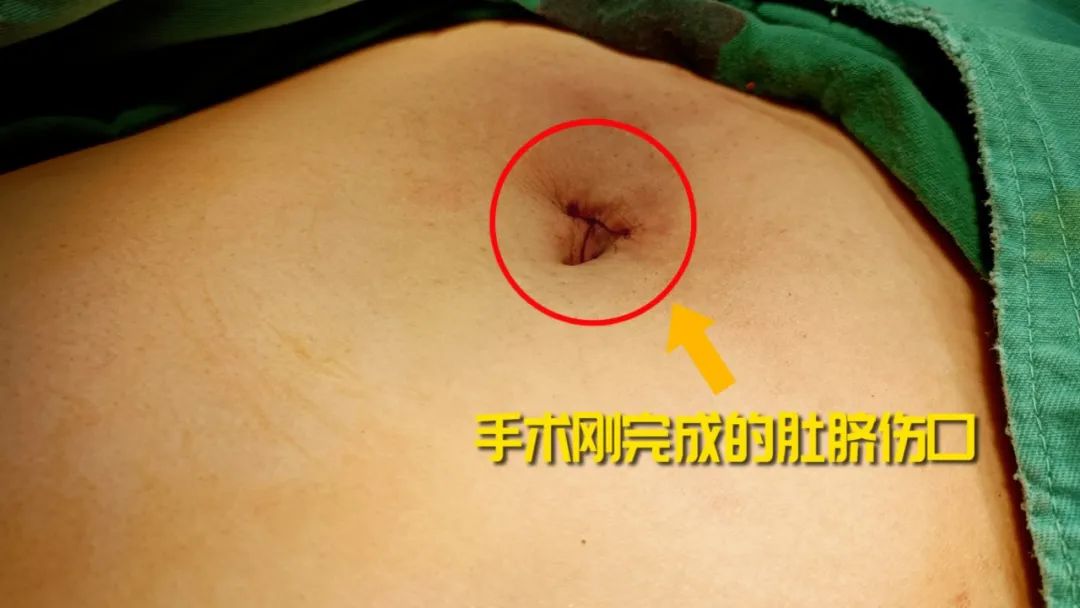 伤口还能这么隐形？聚焦超微创经脐隐瘢痕保胆取石手术【四川胆结石医院】(图1)