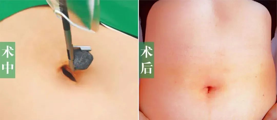 伤口还能这么隐形？聚焦超微创经脐隐瘢痕保胆取石手术【四川胆结石医院】(图3)