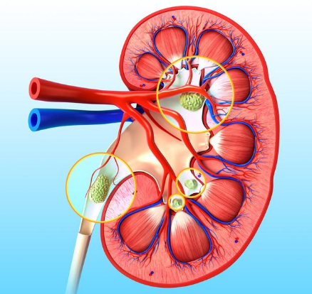 成都治疗肾结石需要多少钱？四川结石病医院详解费用构成(图1)
