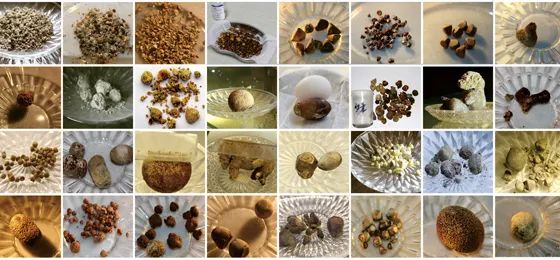 22岁小伙的肾已布满结石！四川结石病医院专家：这些行为正在掏空年轻人(图1)