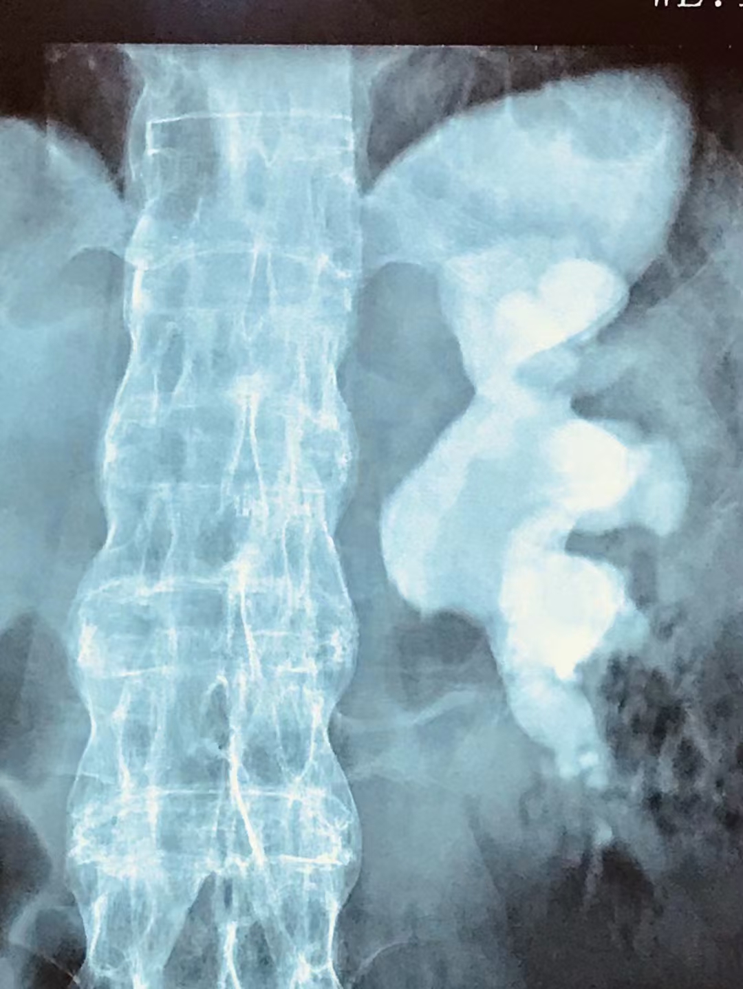 警惕！肾结石发展的5个阶段，越到后面越危险【成都24小时碎石医院】(图2)