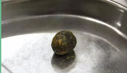 专家揭秘：为什么女性更容易得胆结石？【四川胆结石手术医院】(图2)