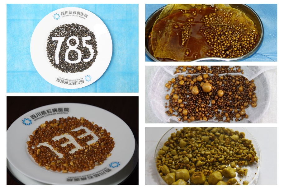 四川眉山女子毫无感觉，胆囊里竟疯长出108颗“好汉结石”【四川保胆取石最好的医院排名】(图5)