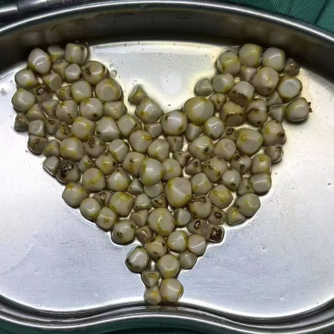 四川眉山女子毫无感觉，胆囊里竟疯长出108颗“好汉结石”【四川保胆取石最好的医院排名】(图1)