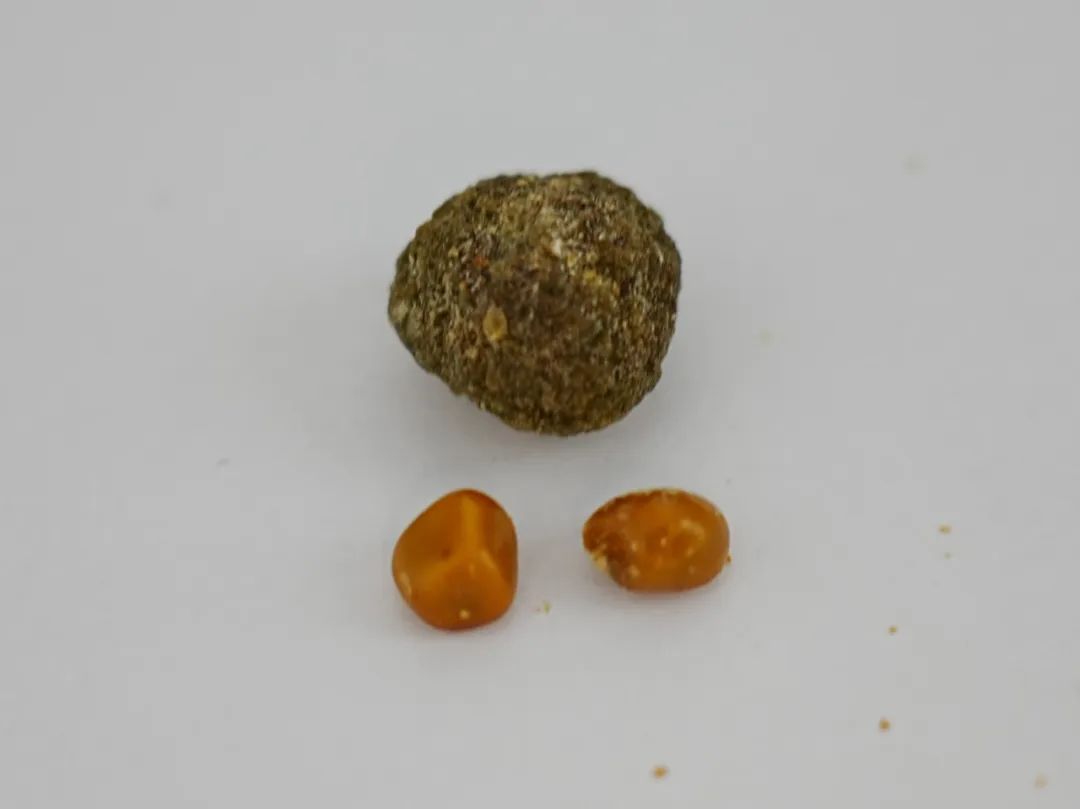 57岁教师面对“结石危机”，猜猜他选保胆还是切胆？【四川结石病专科医院】(图1)