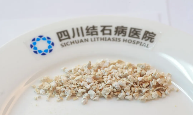 “硬汉”也难敌体内石！专家提醒男性高发，三招防住泌尿结石【成都哪里治疗肾结石】(图2)