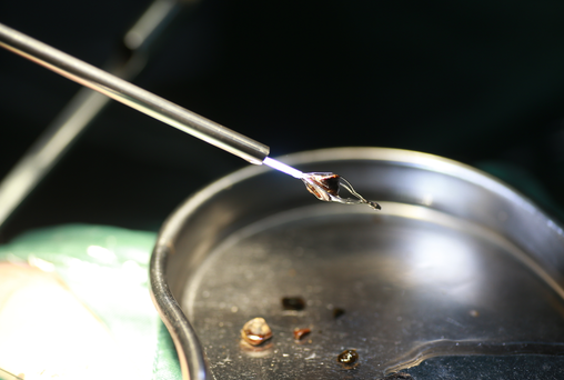 教训惨痛！男子盲目排石酿大祸，竟导致输尿管永久损伤！【四川结石病医院】(图4)