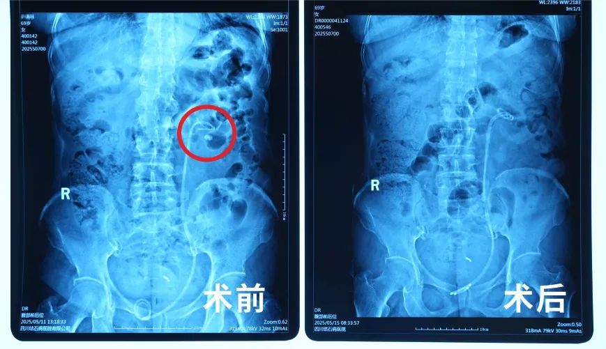 三战结石！当地医生摇头放弃，这家医院却为她卸下“石”压重负【四川结石病医院】】(图2)