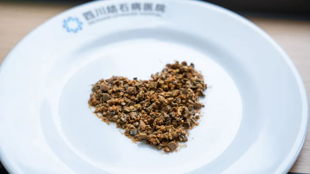 案例分享：又见“巨无霸”！男子肾脏取出8公分铸型结石【四川肾结石专科医院】(图4)