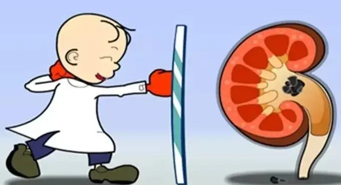 肾结石治疗：体外碎石和手术取石怎么选？专家一次性说清楚【成都肾结石治疗医院】(图4)