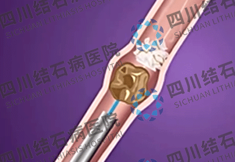 肾结石治疗：体外碎石和手术取石怎么选？专家一次性说清楚【成都肾结石治疗医院】(图7)
