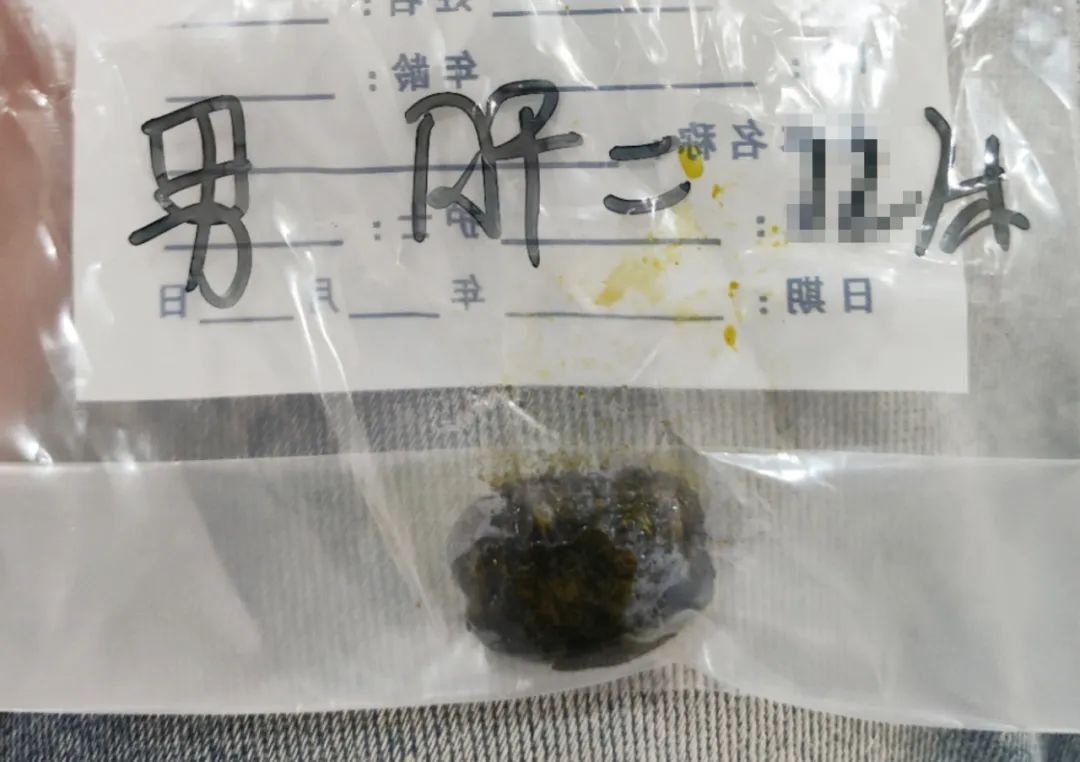 甘肃患者跨省到四川结石病医院圆保胆梦，患者：找对专业医院最关键(图2)