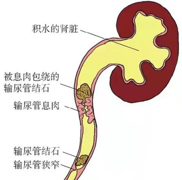 肾积水——被忽视的肾脏健康杀手，早发现才能保肾脏！【四川结石病专科医院】(图2)