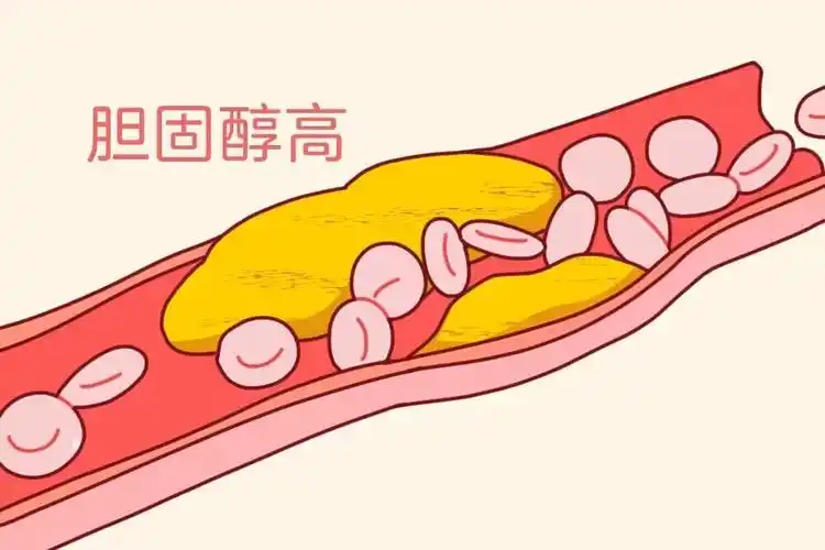 脂肪的双刃剑：是胆囊守护者，还是结石帮凶？【成都哪里能保胆取石】(图2)