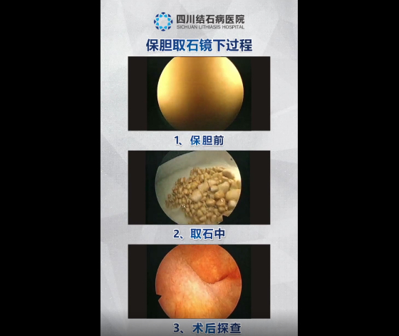 胆囊健康科普宣传周：犹豫“切胆”还是“保胆”？看完就不纠结了！【成都保胆取石医院】(图4)