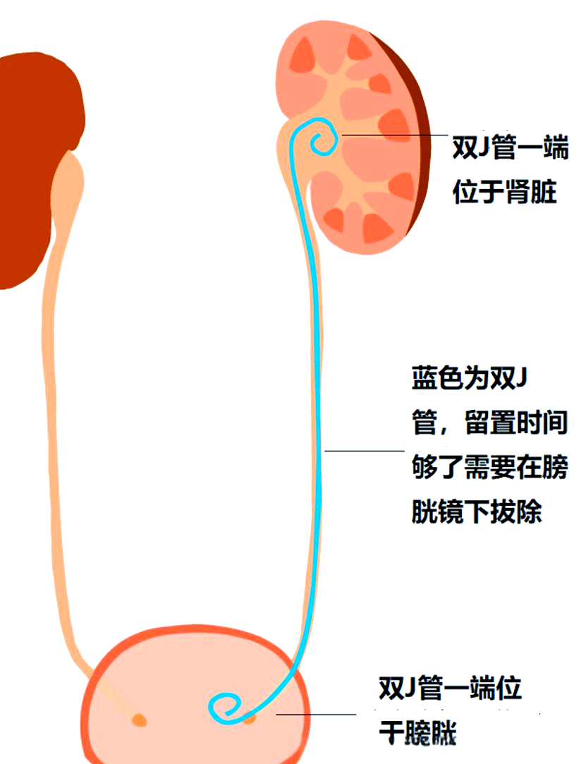 肾结石术后必知干货：双J管的作用、留置时间与3个关键注意事项！【四川肾结石专科医院】(图2)