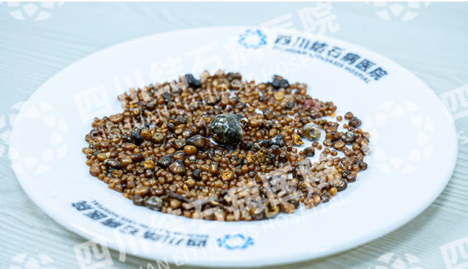 都江堰患者胆囊惊现1343颗结石 拖延治疗致胆囊坏疽【四川胆结石专科医院】(图2) 都江堰患者胆囊惊现1343颗结石 拖延治疗致胆囊坏疽【四川胆结石专科医院】(图2)