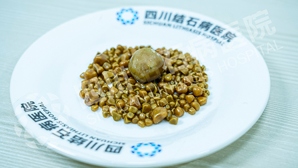 无症状≠无风险!40岁女子突发腹痛,四川结石病医院保胆取出275颗结石(图1) 无症状≠无风险!40岁女子突发腹痛,四川结石病医院保胆取出275颗结石(图1)