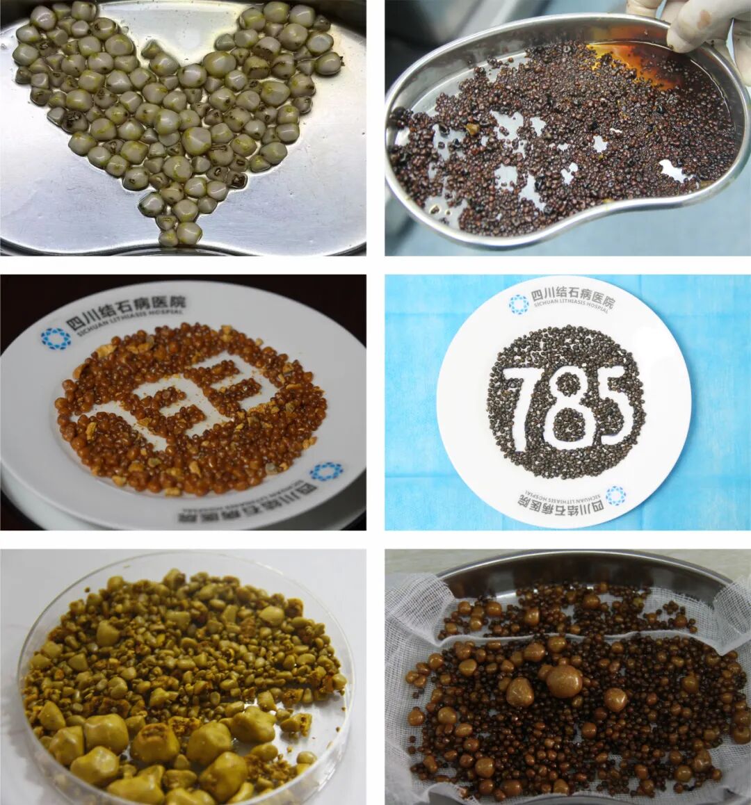 126颗结石藏胆囊!杭州男子赴川保胆手术登热搜,这些风险别忽视(图5) 126颗结石藏胆囊!杭州男子赴川保胆手术登热搜,这些风险别忽视(图5)