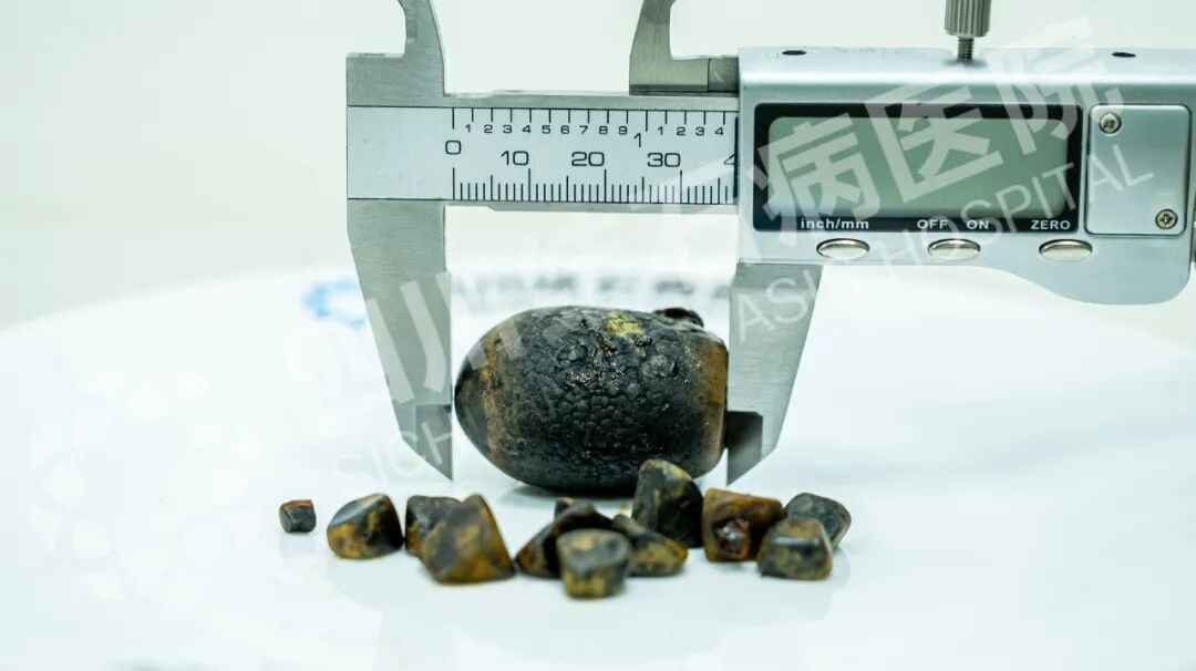 国庆聚餐后突发剧痛！成都女子保胆取出4厘米“鸽子蛋”结石【四川胆结石医院】(图1)