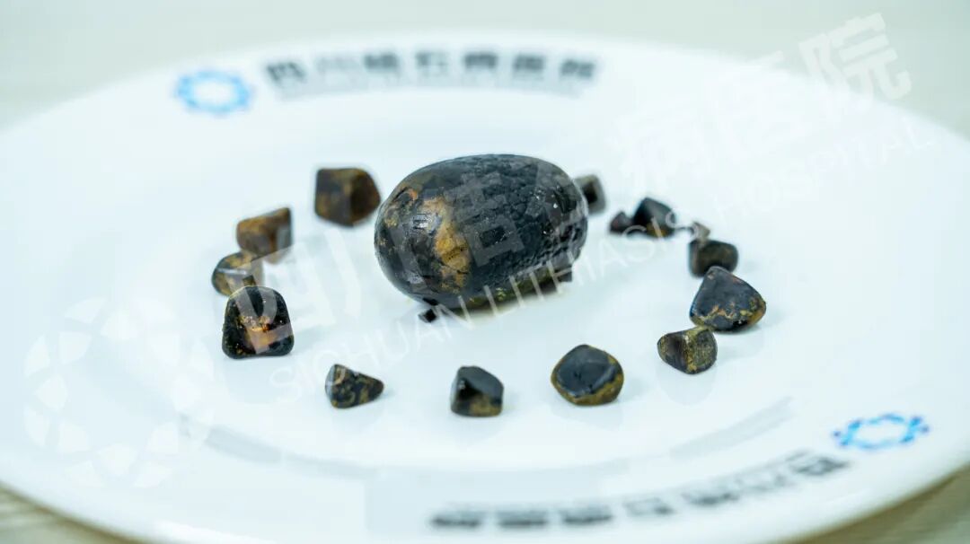 国庆聚餐后突发剧痛！成都女子保胆取出4厘米“鸽子蛋”结石【四川胆结石医院】(图2)