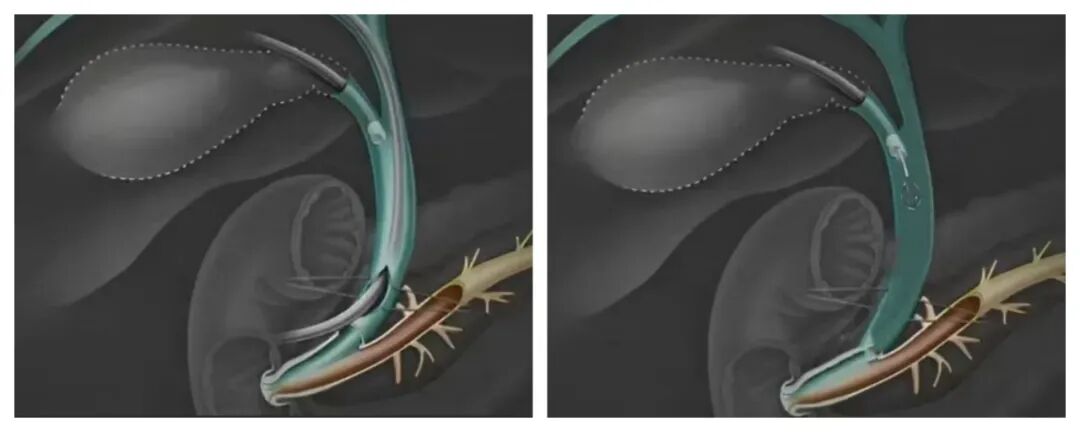 胆总管结石治疗“无管化”：64岁患者受益这项技术，更微创、恢复更快【四川结石病专科医院】(图1)