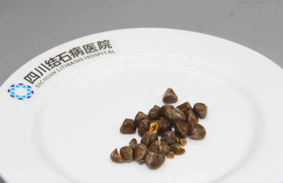 胆结石患者日常养护指南：饮食+生活习惯双管齐下，守护胆囊健康【四川胆结石专科医院】(图3)