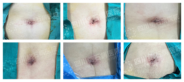 警惕!结石长期不重视可能癌变,这2个高危饮食习惯赶紧改【四川胆结石专科医院】(图5) 警惕!结石长期不重视可能癌变,这2个高危饮食习惯赶紧改【四川胆结石专科医院】(图5)