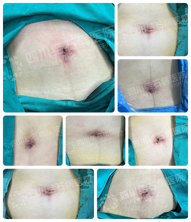 胆结石的3个黄金干预期，很多人都错过了！别等切胆囊才后悔【四川胆结石专科医院】(图5)