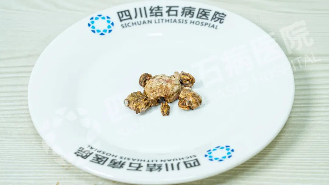 生死时速！胆结石发作保守治疗后，女子竟险遭生命危险！【四川结石病医院】(图5)