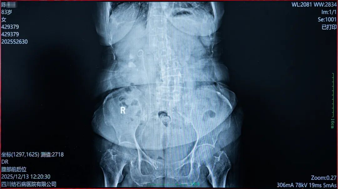 八旬奶奶“除石”记：当右肾铸型结石遇上医者仁心【四川结石病医院】(图5)