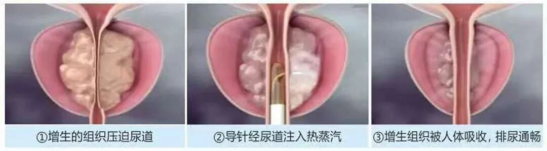 跨越3000公里的信任：新疆老人来蓉求医为“瑞梦”【四川瑞梦热蒸汽医院】(图6)