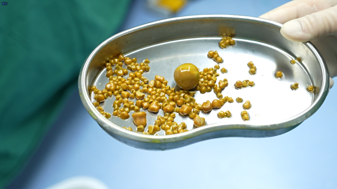 2025年度|四川结石病医院肝胆外科：深耕亚专科，绘就精准医疗蓝图(图4)