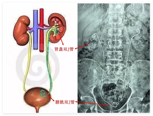 泌尿结石还能实现“舒适取石”？四川结石病医院做到了！(图3)