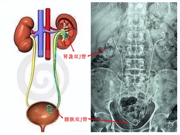 无管更自在！输尿管结石无管化技术，告别插管之苦【四川结石病医院】(图1)