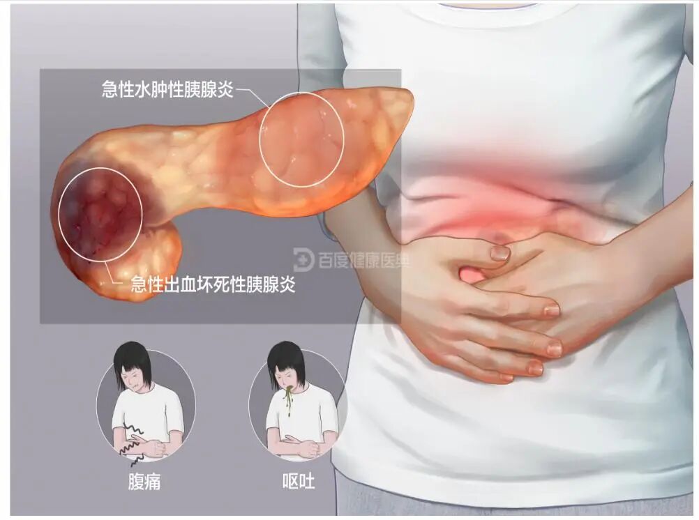 沉默的胆囊结石：不痛不痒，却可能悄悄“引爆”肝胰危机【四川结石病医院】(图3)