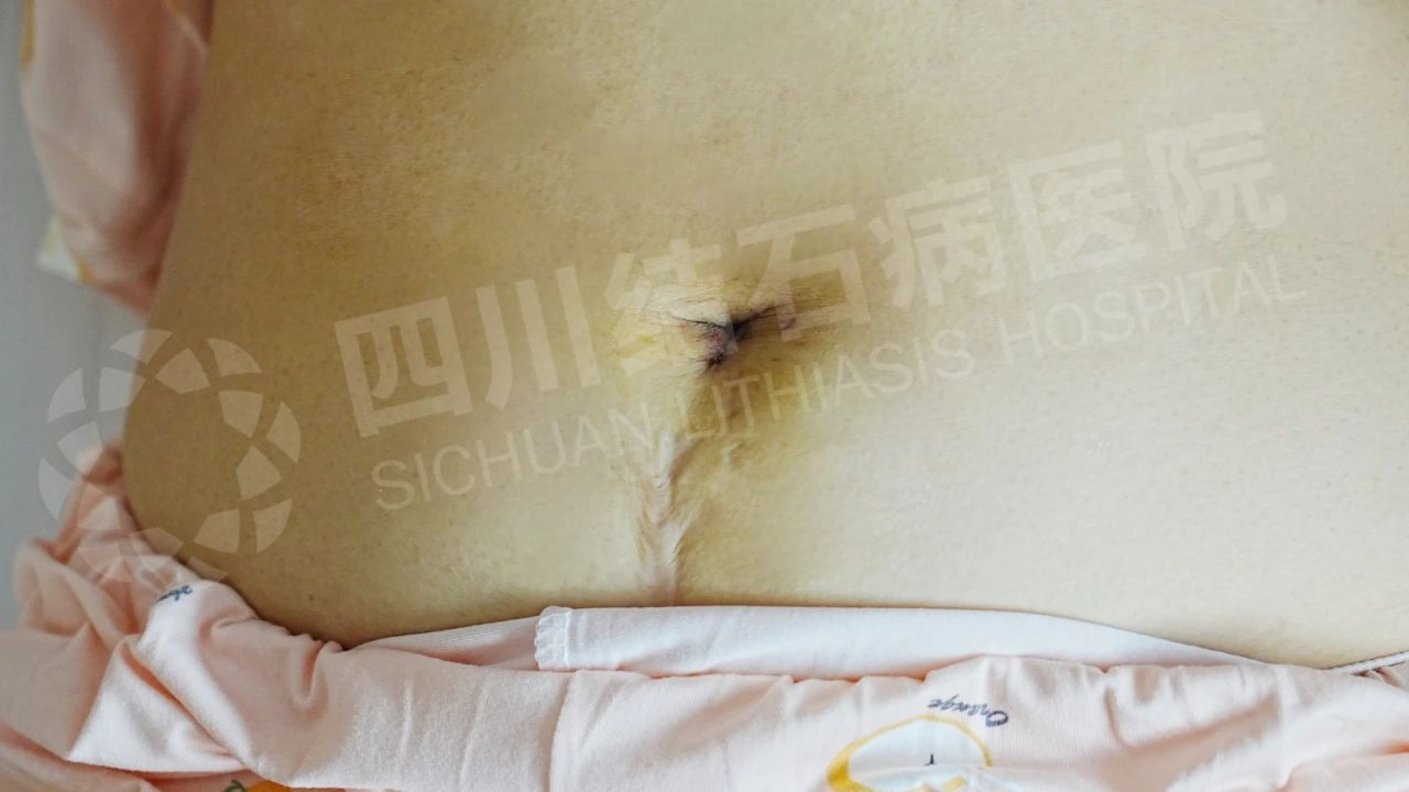 保胆又隐痕！经脐技术让患者直呼：这简直是胆结石患者的福音(图2)