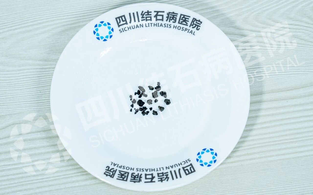 23岁男子春节急诊入院 超微创保胆守护团圆年(图1)