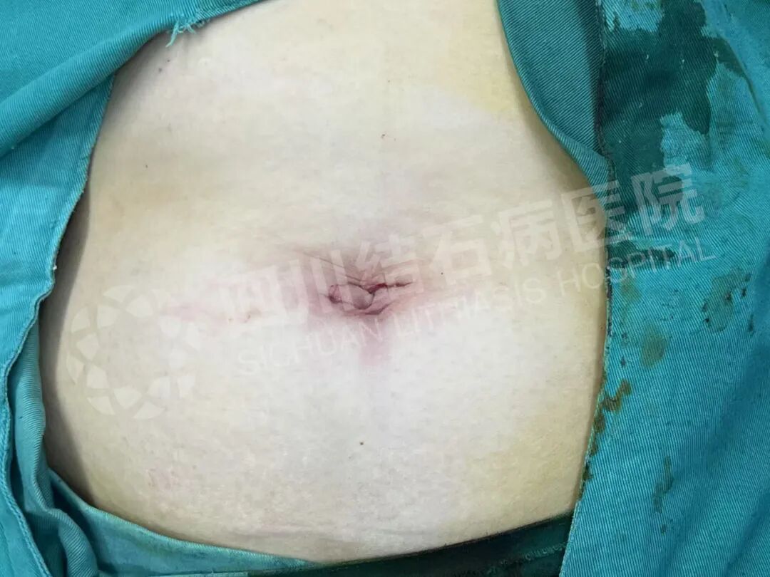 四川结石病医院:节后结石患者“扎堆”,这些“元凶”你得防!(图3) 四川结石病医院:节后结石患者“扎堆”,这些“元凶”你得防!(图3)