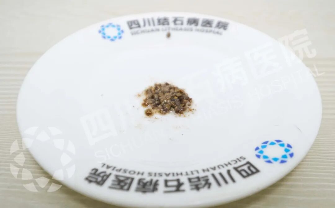 四川结石病医院:节后结石患者“扎堆”,这些“元凶”你得防!(图5) 四川结石病医院:节后结石患者“扎堆”,这些“元凶”你得防!(图5)