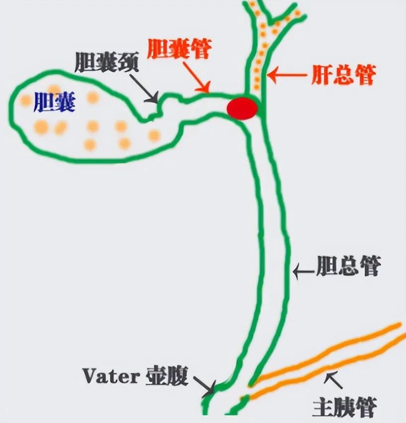 胆结石不痛，为啥还要手术？背后真相很多人不知道 | 四川结石病医院(图3)