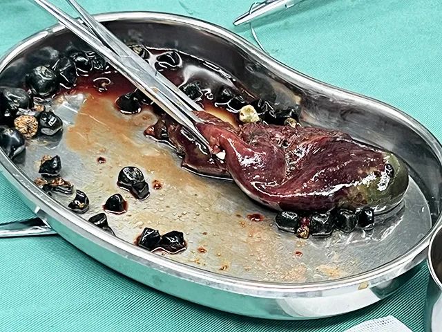 为什么得胆囊结石的人越来越多了？小心这些行为，你可能每天都在做！【四川结石病医院】(图4)