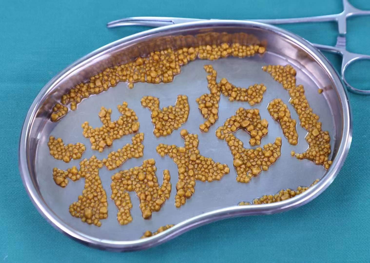 为什么得胆囊结石的人越来越多了？小心这些行为，你可能每天都在做！【四川结石病医院】(图5)